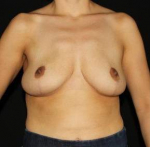 Breast Reduction - Case #4 After